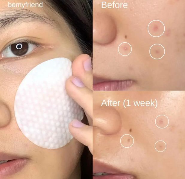 Фото Пілінг пади для очищення та звуження пор Medicabe Zero Pore Pads 2.0 70 шт. 100206,